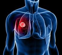 Image result for Lung Cancer