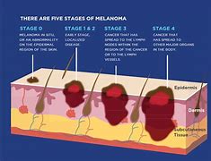 Image result for Stage 4 Melanoma