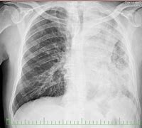 Image result for Stage 4 Lung Cancer Patients
