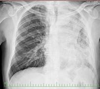 Image result for Lung Cancer Photos