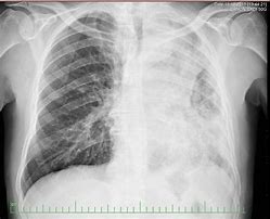 Image result for Small Cell CA Lung