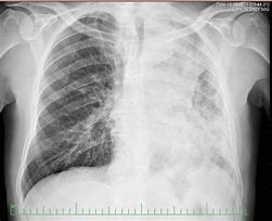 Image result for Small Cell Lung Cancer Chest X-Ray