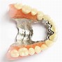 Image result for Permanent False Teeth