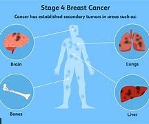 Image result for Stage 4 Cancer