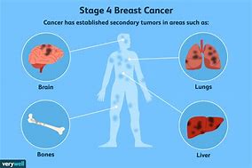 Image result for Stage 4 Tumor Cancer
