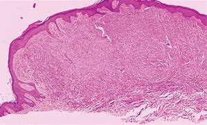 Image result for Melanoma Histology