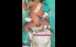 Image result for Hypospadias Photos Newborn