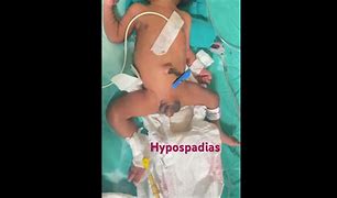 Image result for Hypospadias Newborn