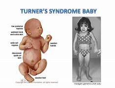 Image result for Turner Syndrome Babies