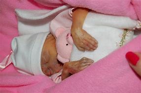 Image result for Trisomy 13 Babies