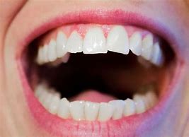 Image result for Cartoon Mouth with Missing Teeth