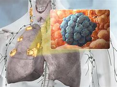 Image result for Stage IV NSCLC Lung Cancer