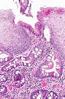 Image result for Esophagus Cancer Stage 4