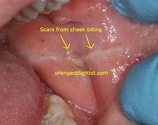 Image result for Dent in Cheek