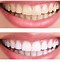 Image result for Teeth Porcelain Veneers Before and After