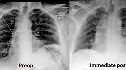Image result for Diaphragm Plication