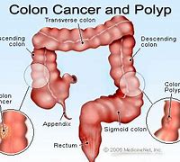 Image result for Colon Cancer Poop Pictures