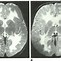 Image result for Canavan Disease Brain
