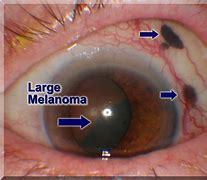 Image result for Melanoma in Eye