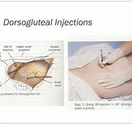 Image result for Dorsoogluteal Injection Site