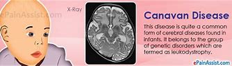 Image result for Outcome of Canavan Disease