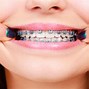 Image result for Orthodontic Braces Colors