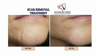 Image result for Scar Removal Surgery