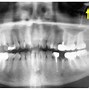 Image result for Panoramic X-ray Landmarks