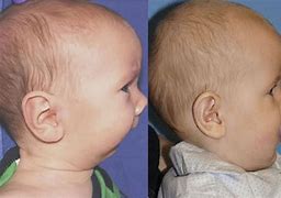Image result for Pierre Robin Syndrome Trisomy 13