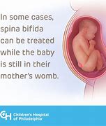 Image result for Spina Bifida