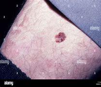 Image result for Non-Cancerous Skin Blemishes