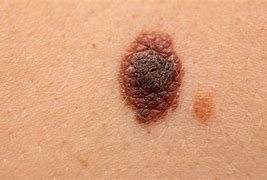Image result for Early Stage Malignant Melanoma