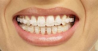 Image result for Clear Invisible Braces