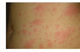 Image result for Covid 19 Vaccine Rash