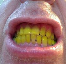 Image result for Freema Agyeman Teeth