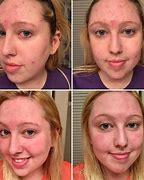 Image result for Vitamin C Injections Before and After