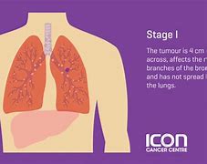 Image result for How Long to Live with Stage 3 Lung Cancer