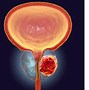 Image result for Prostate Cancer