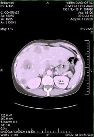 Image result for Adenocarcinoma Colon Cancer Stage 4