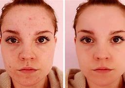 Image result for What Are Blemishes On Face