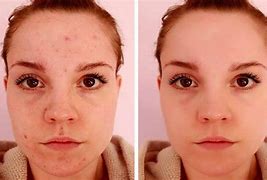 Image result for Skin Blemishes On Face