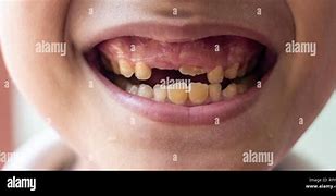 Image result for Dents Pourries Enfants