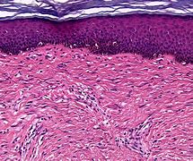 Image result for Skin Scar Tissue