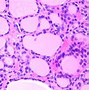 Image result for Thyroid Gland Cancer
