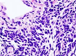 Image result for Small Cell Lung Cancer Stages