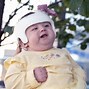 Image result for Birth Defects Trisomy 18