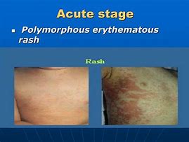 Image result for Kawasaki Disease Rash