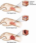 Image result for 3rd Degree Burn Victims