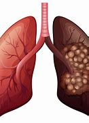 Image result for First Stage Lung Cancer