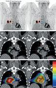 Image result for Pet Scan B-cell Lymphoma Stage 4